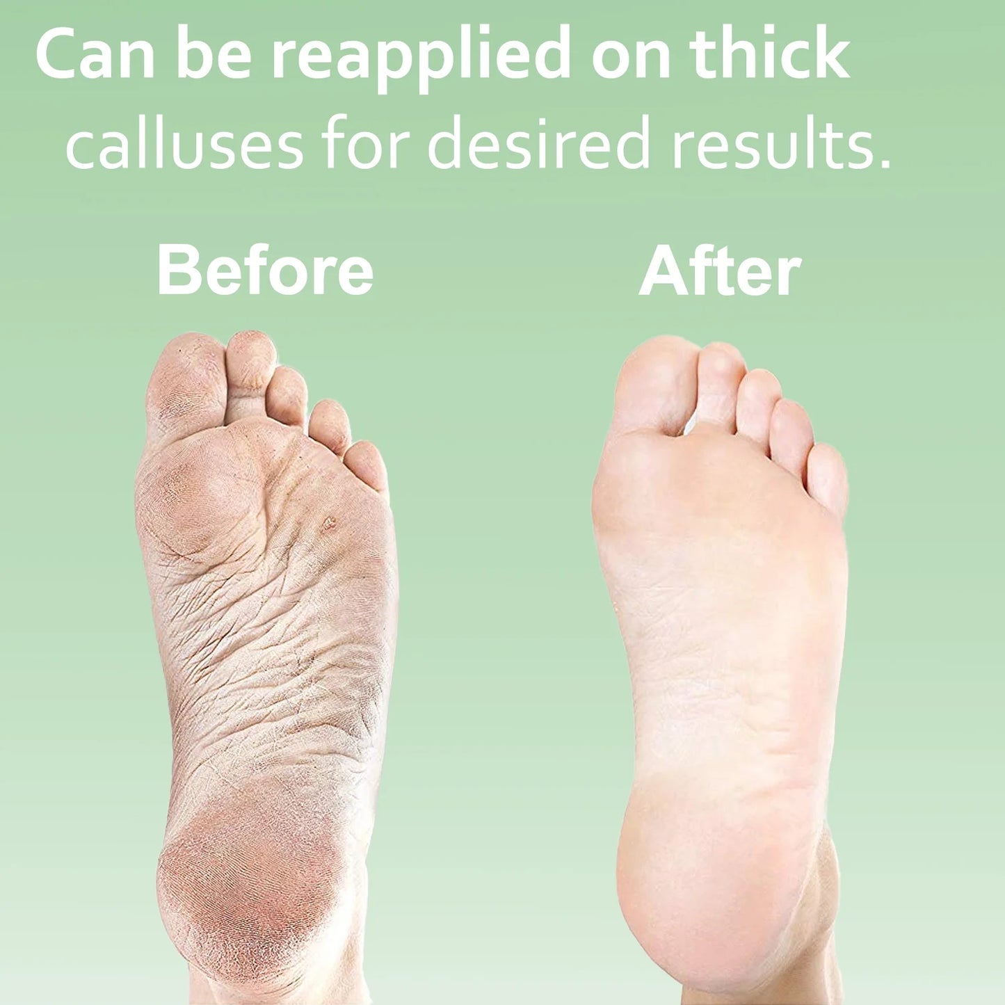 Dr. Entre'S Callus Remover for Feet: Callus Remover Gel, Foot Callus Remover, Pedicure Kit Tools Supplies, Spa Kit, Dead Skin Scrubber,