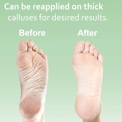 Dr. Entre'S Callus Remover for Feet: Callus Remover Gel, Foot Callus Remover, Pedicure Kit Tools Supplies, Spa Kit, Dead Skin Scrubber,