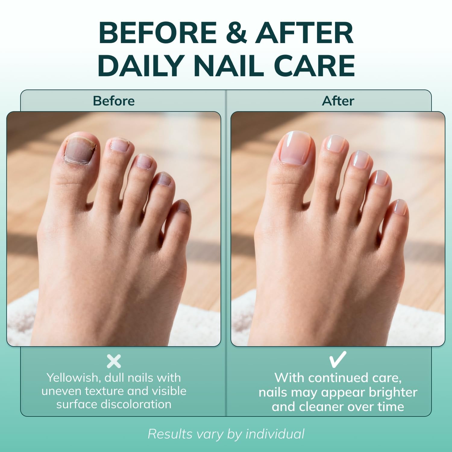 Klearnail Toenail Stick | Medi-Care Treatment | Natural Solution for Healthy Nails I Suitable for Foot, Toe, and Fingernail I for Brittle Toenails – 10Ml / 0.3 Fl. Oz. Pack 1 - Made in USA